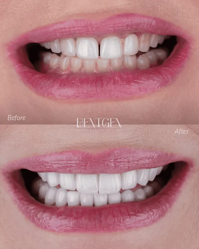 Real DentGen dental before and after result