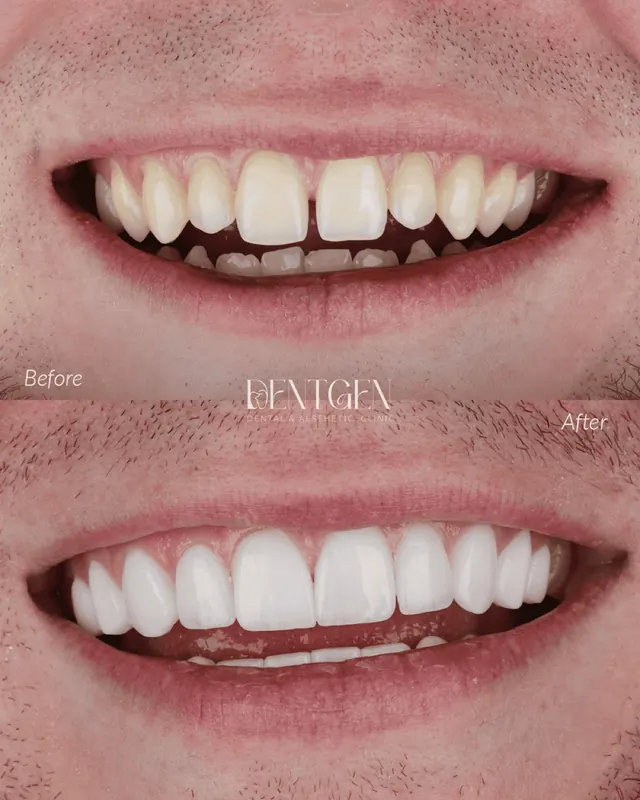 Real DentGen dental before and after result
