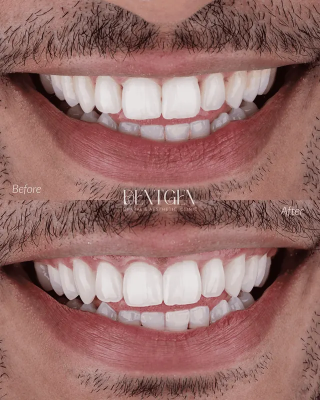 Real DentGen dental before and after result