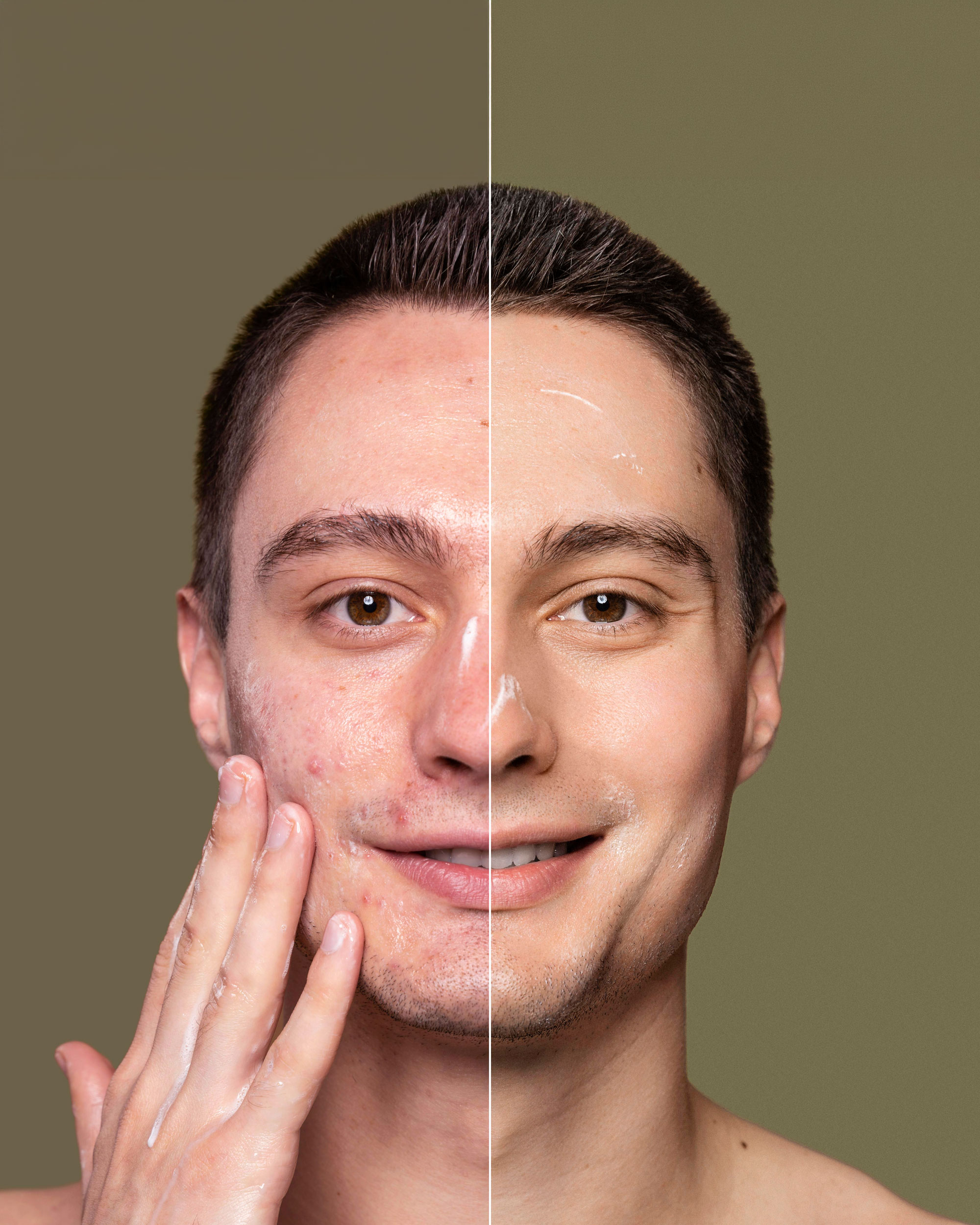 Acne & Scar Treatment in Dubai