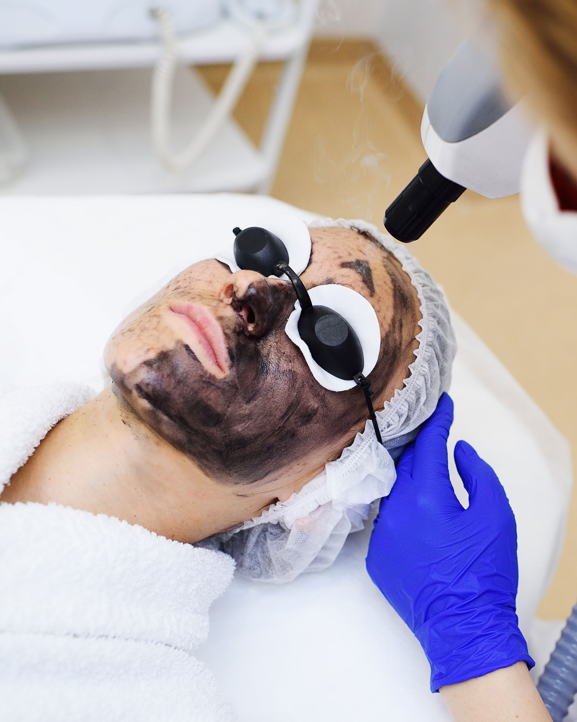 Carbon Laser Peel in Dubai