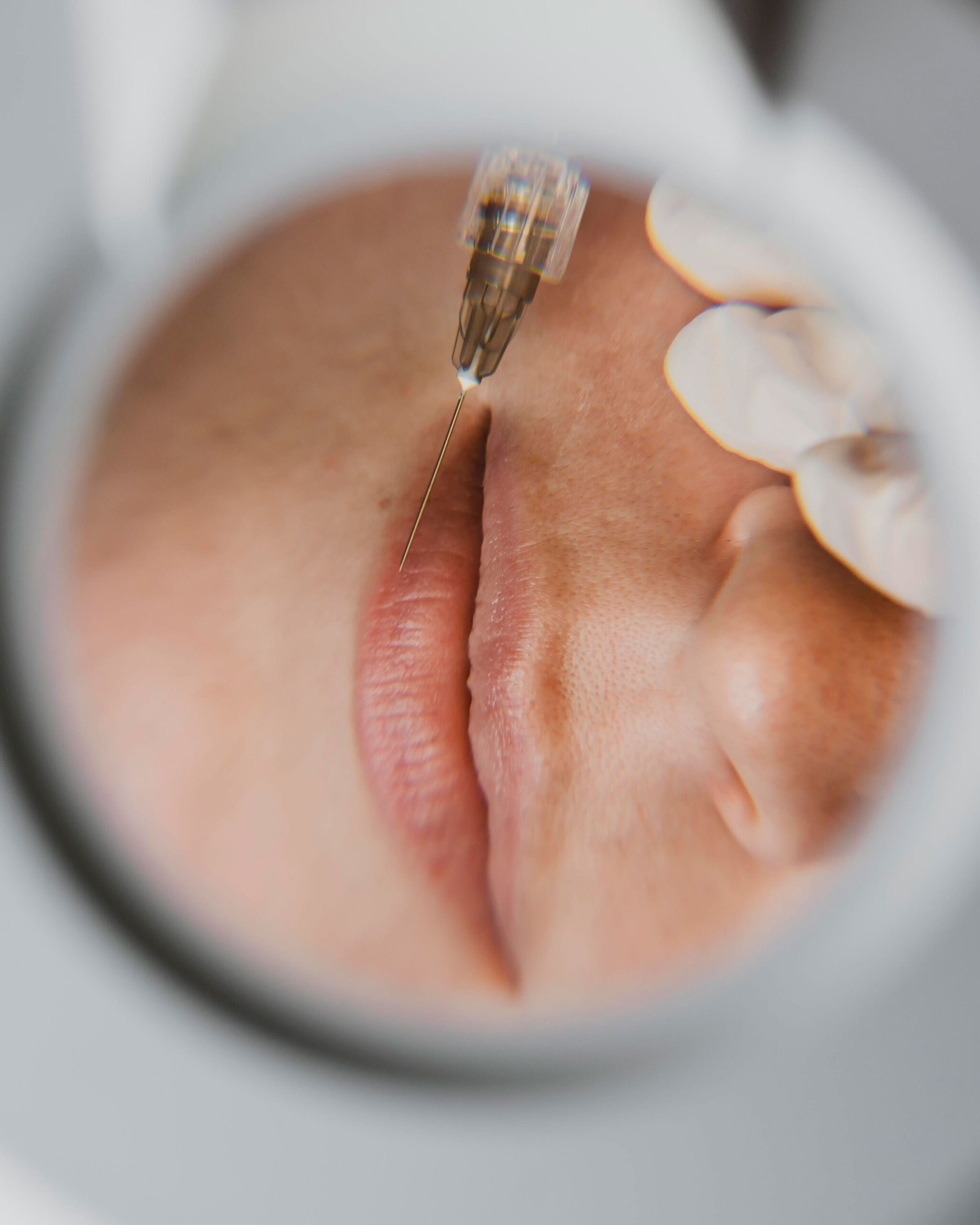 Lip Augmentation in Dubai