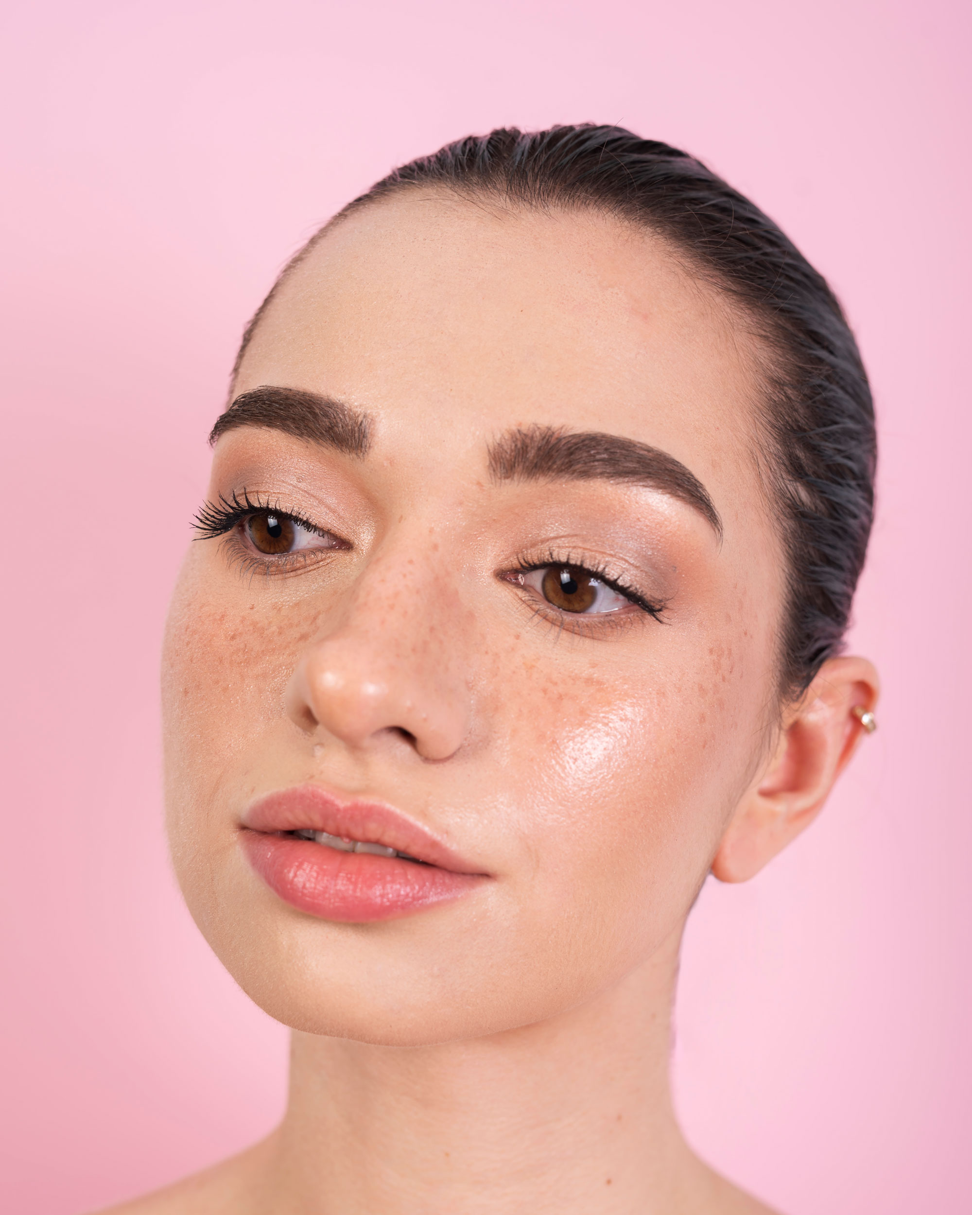 Pigmentation Treatment in Dubai