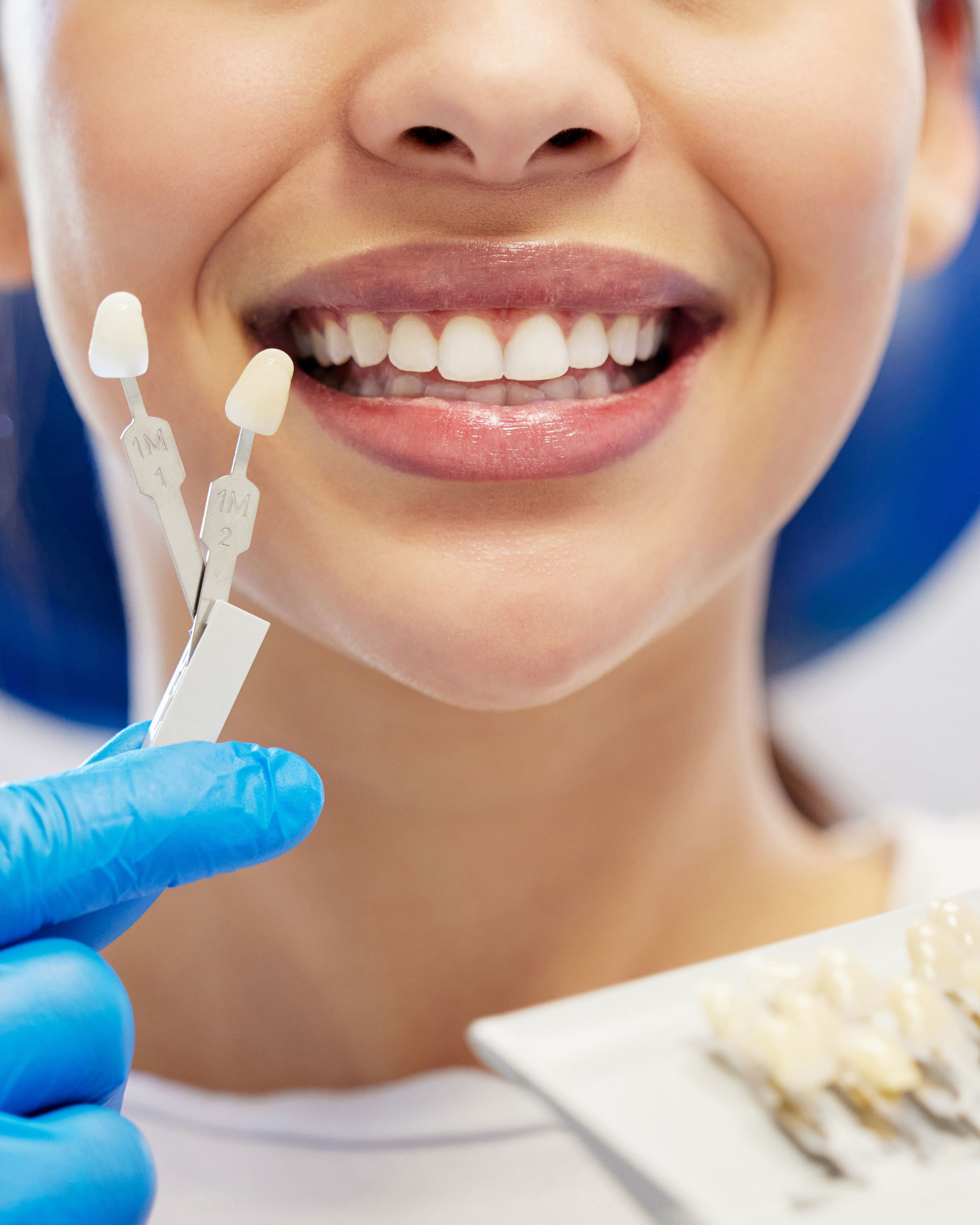 Dental Veneers in Dubai