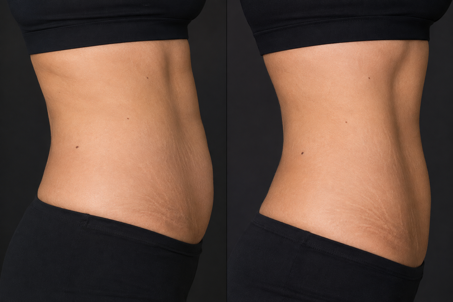 Flank Endolift in Dubai