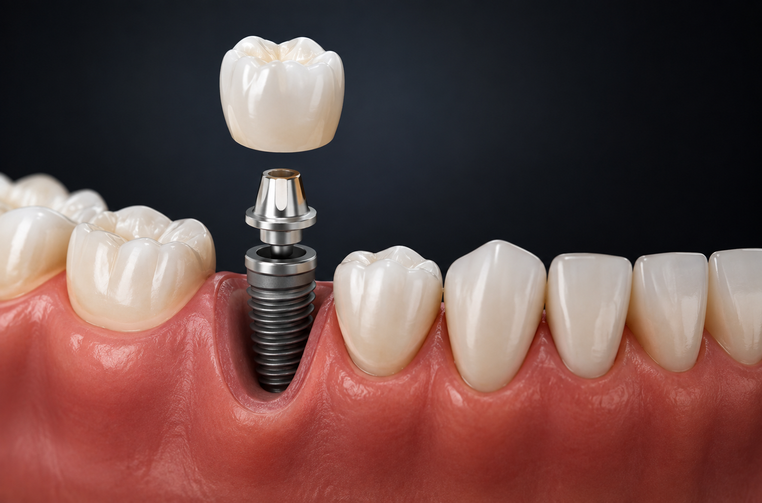 Swiss Implants in Dubai